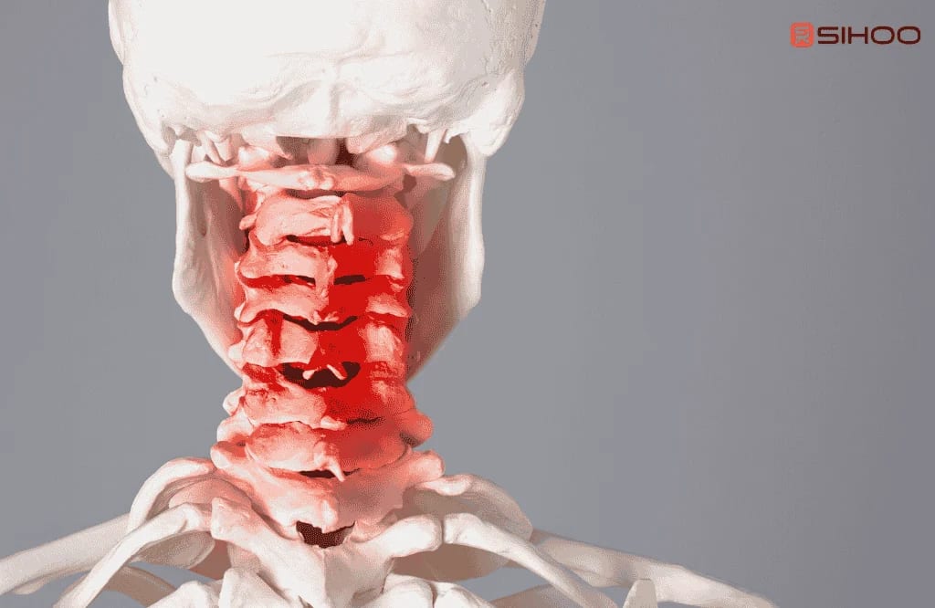 Illustration anatomique montrant les vertèbres cervicales rouges et la zone de tension du cou, représentant la douleur cervicale due à une mauvaise posture assise.