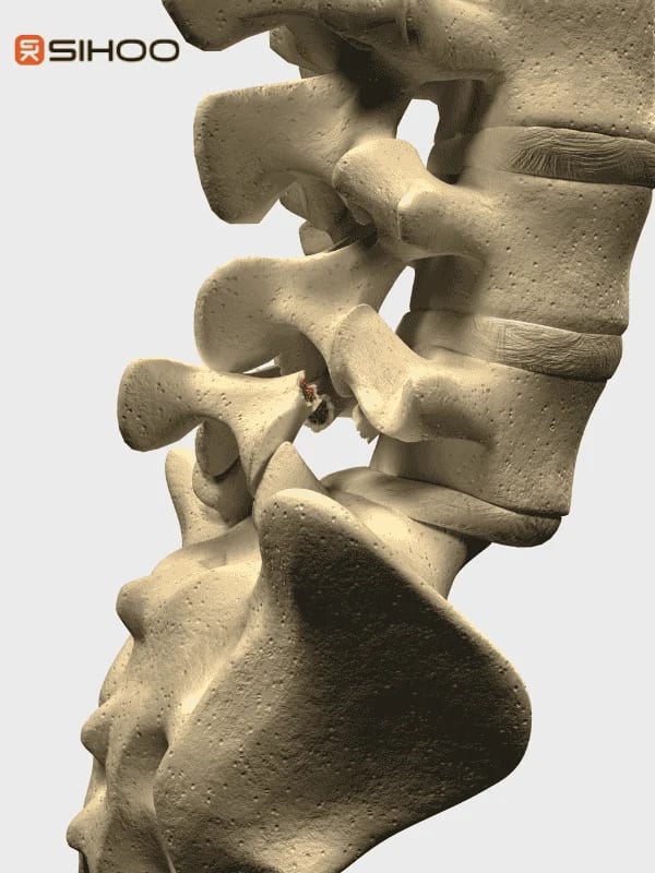 Image anatomique du rachis lombaire montrant une spondylolyse (fissure de l’isthme).